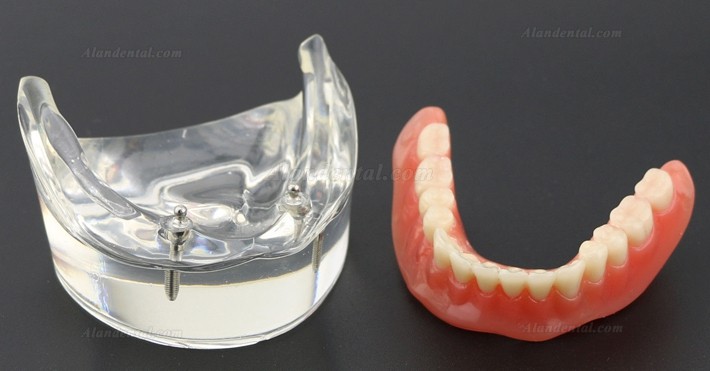 Dental Teeth Model Overdenture Inferior with 2 Implants Study Demo Model 6002 01